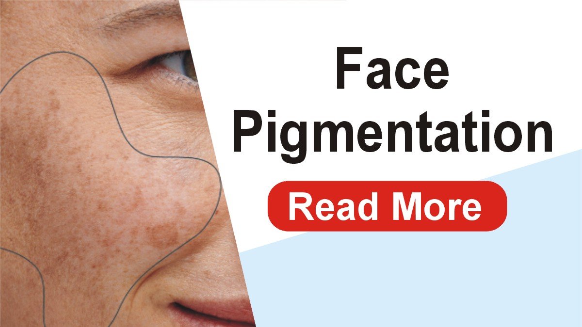 Face Pigmentation – Causes, Treatment, and Expert Tips